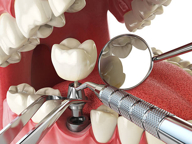 Best Emergency Root Canal Treatment in Antioch, IL