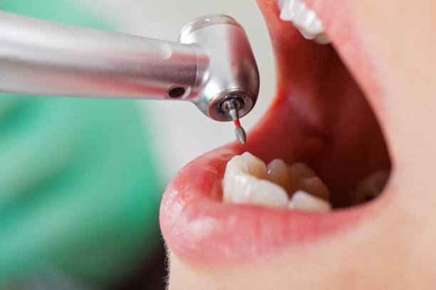 Best Emergency Wisdom Teeth Removal in Antioch, IL